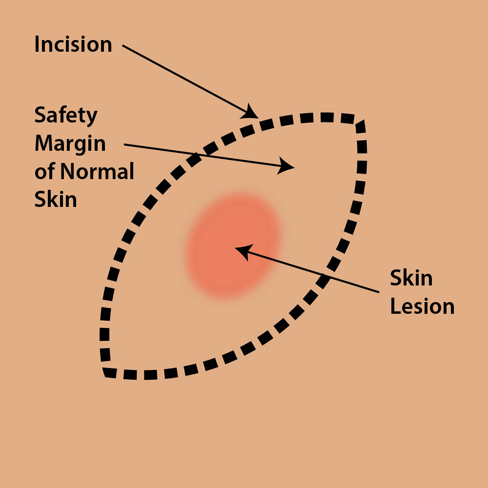 Excision of All Types of Skin Cancer